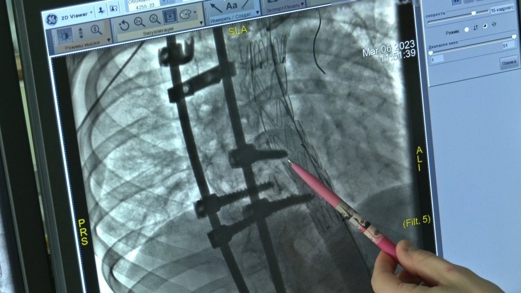 Снимок МСКТ, показывающий опасную картину до операции.jpg
