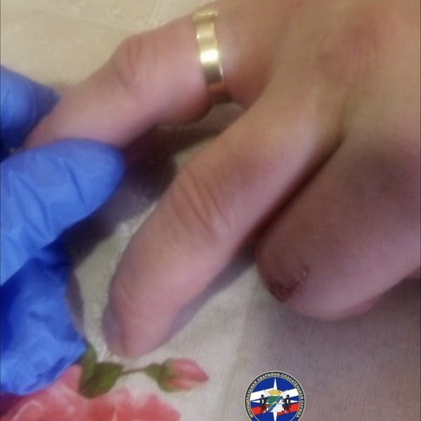 Спасатели помогли мужчине снять кольцо с безымянного пальца