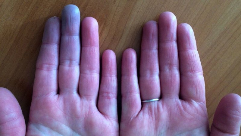 От перенесенного коронавируса пальцы могут стать фиолетовыми