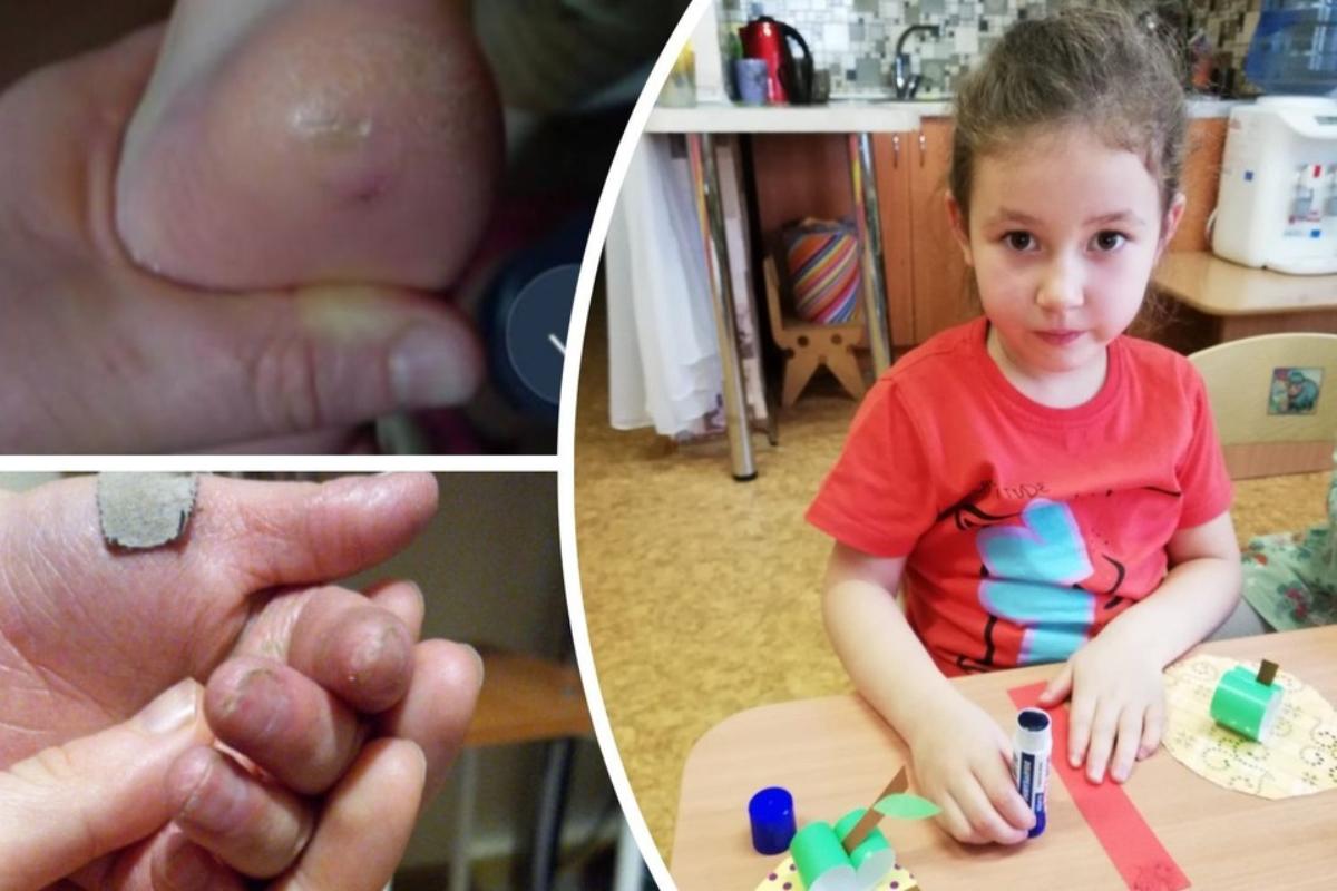 В Новосибирске собрали деньги на генетический тест брошенной отцом девочке с кожей «бабочки»