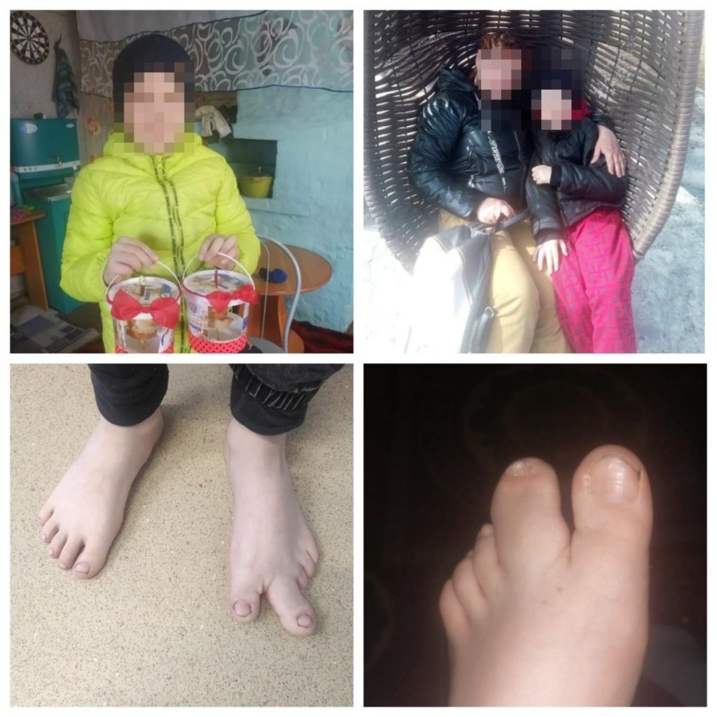 Палец-гигант на ноге ребенка исправили новосибирские хирурги