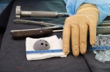 Хирурги НИИТО имплантировали сустав женщине с «детскими» бедренными костями
