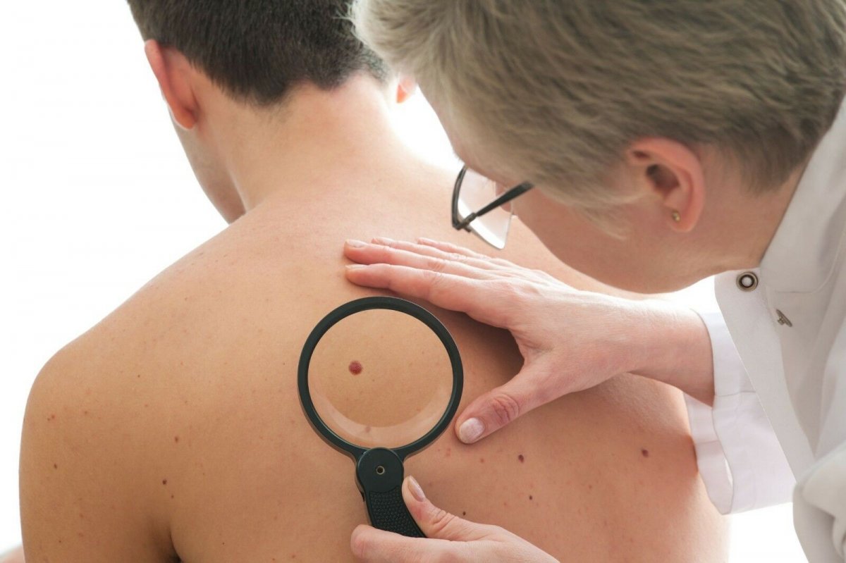Самые важные симптомы, которые могут говорить о наличии рака кожи