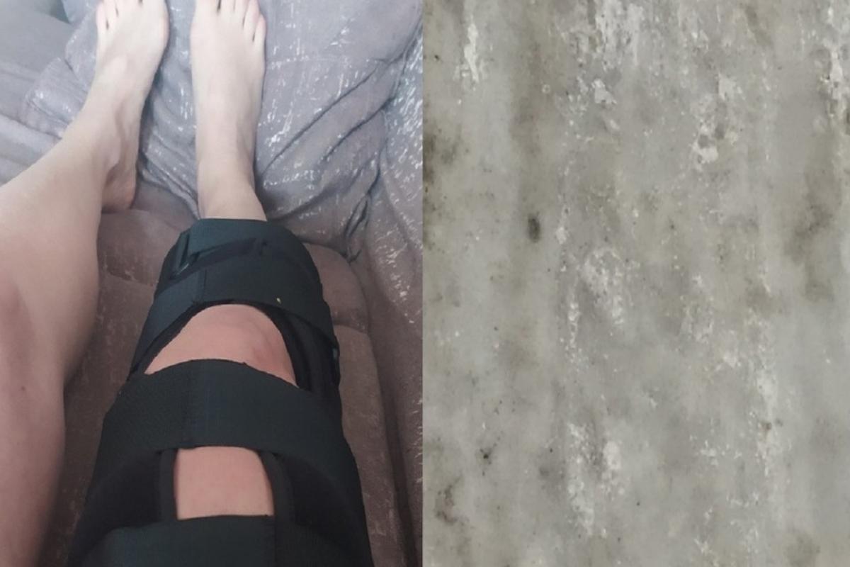 Жительница Новосибирска сломала ногу на гололеде у подъезда – нужно 140 тысяч на операцию