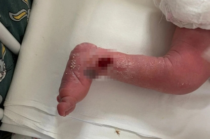«Зачем рожаешь, если не умеешь?»: сибирячка пожаловалась, что в роддоме ее сыну сломали ногу