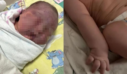Ребенок обмяк и посинел: акушеров обвинили в травмировании новорожденного
