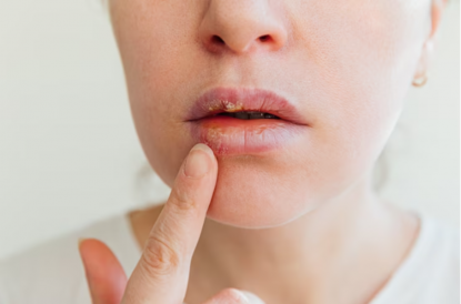Герпес на губах: что делать, если под рукой нет специальной противовирусной мази