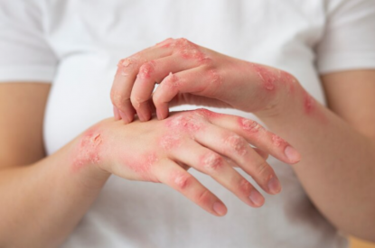 Как проблемы с микрофлорой кишечника отражаются на коже: это важно знать
