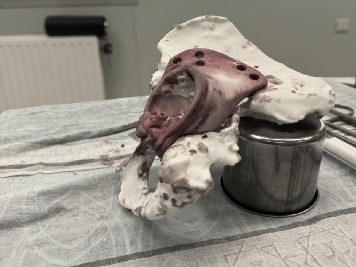 Новосибирцы напечатали первый 3D-эндопротез 70-летней пациентке