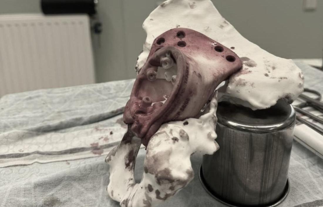 Специалисты напечатали на принтере имплант для тазовой кости в Новосибирске
