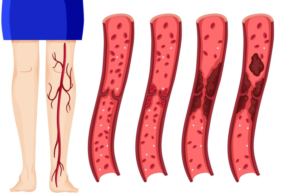 Натуральное средство от густой крови – принимайте в качестве профилактики тромбов