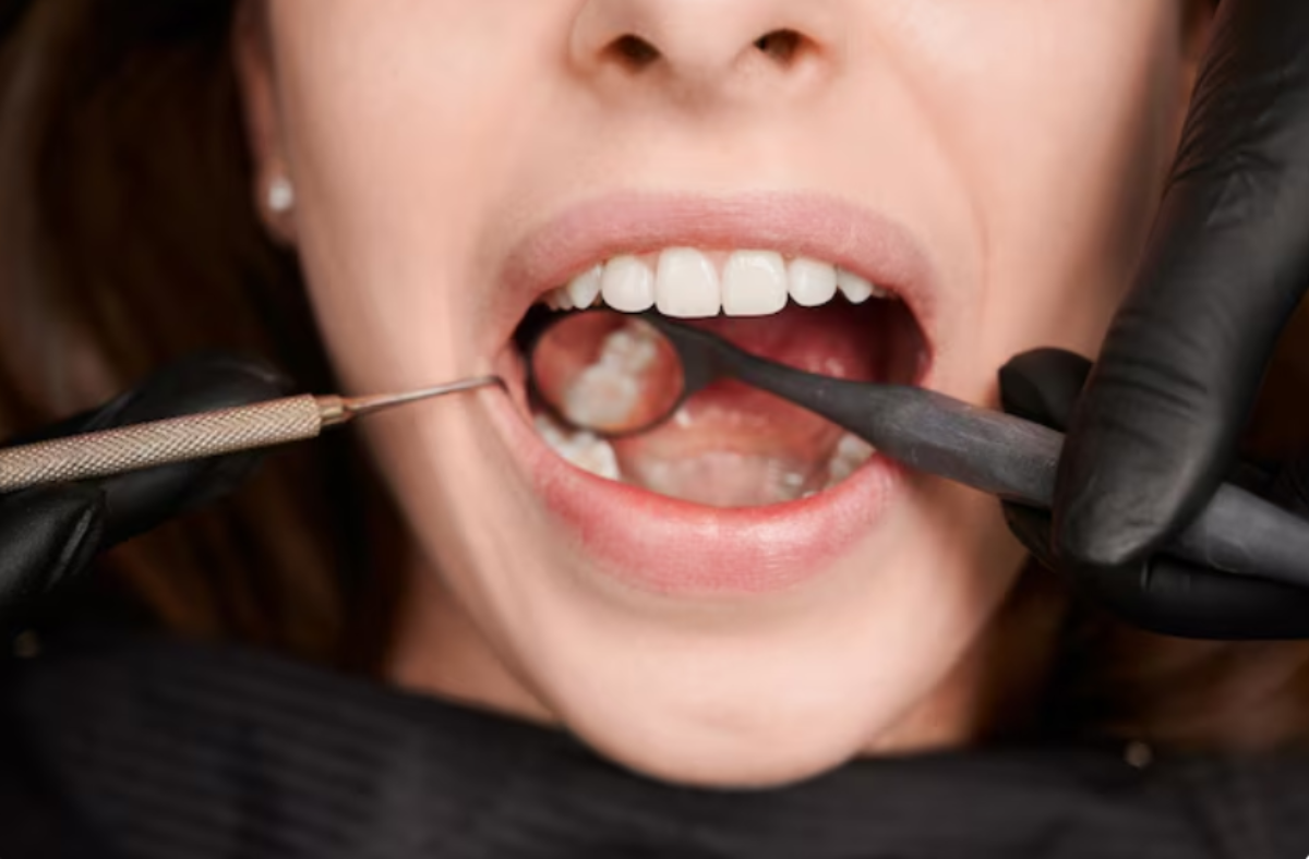 По-вашему, самый большой риск при кариесе – потерять зуб? Есть последствия пострашнее