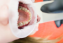 Если будете продолжать в том же духе, лишитесь зубов: привычки, вызывающие зубной камень