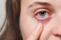 Можно ослепнуть: в каких случаях покраснение глаз – серьезная проблема
