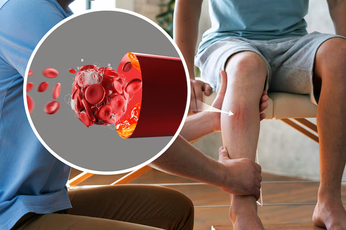 Ваша жизнь может быть под угрозой: сигналы о формировании тромба в ногах