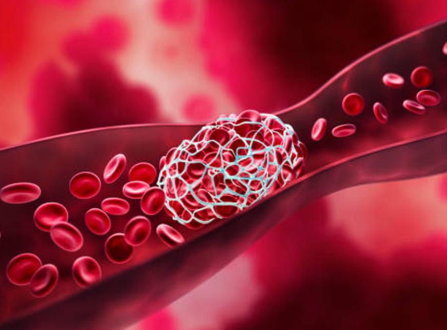 Если боитесь тромбов, сдайте эти анализы: они покажут, находитесь ли вы в группе риска