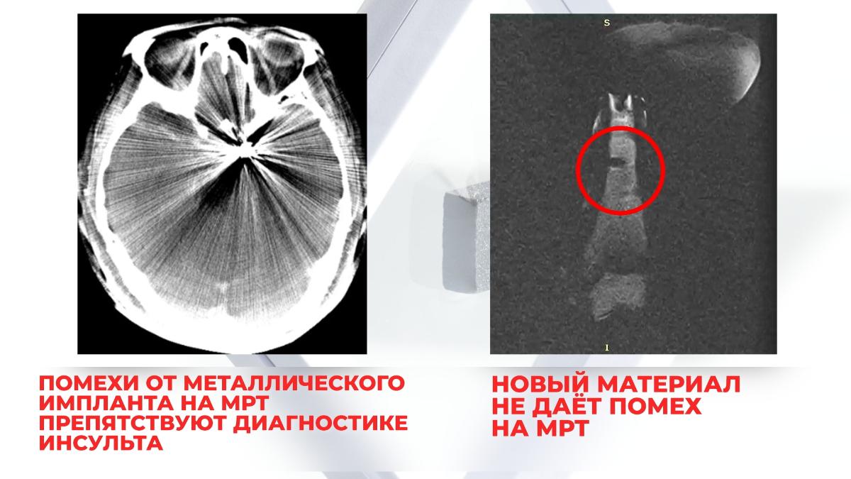 Биоинженеры изобрели сверхпрочный материал для протезирования костей