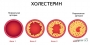 Можно ли очистить сосуды от «плохого» холестерина: ученые предлагают новые варианты